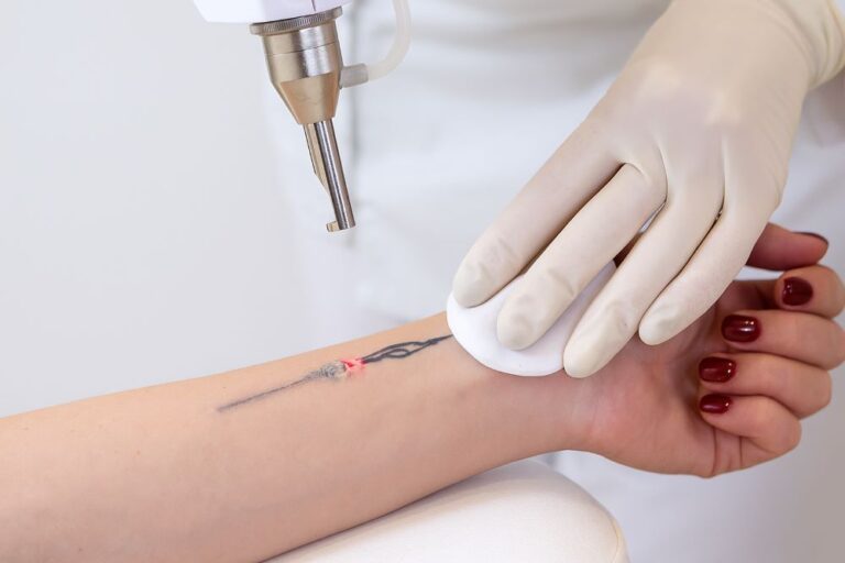 Laserowe usuwanie tatuażu