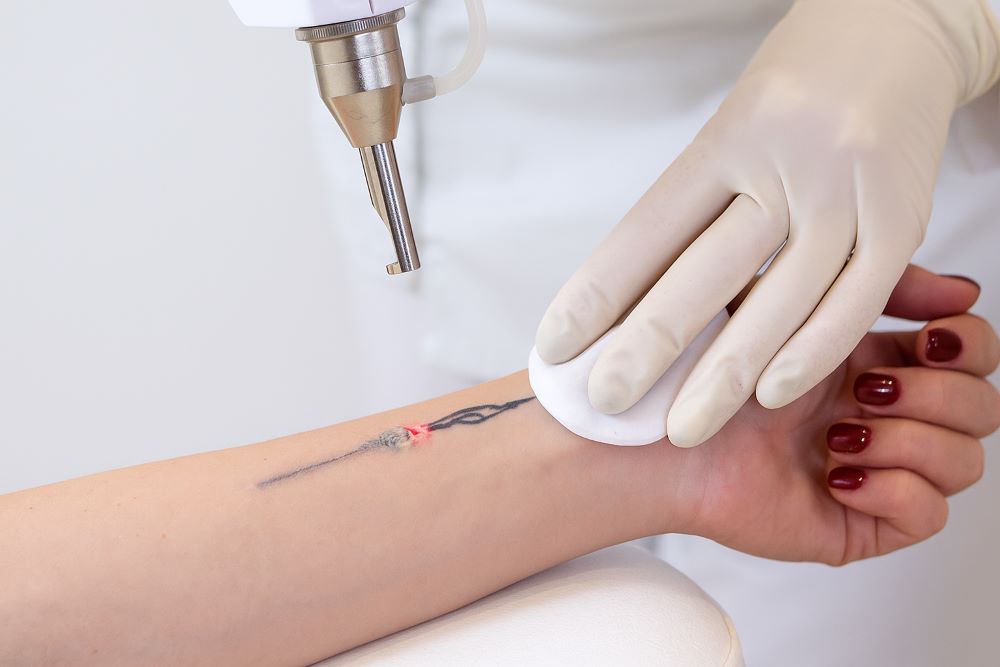 Laserowe usuwanie tatuażu